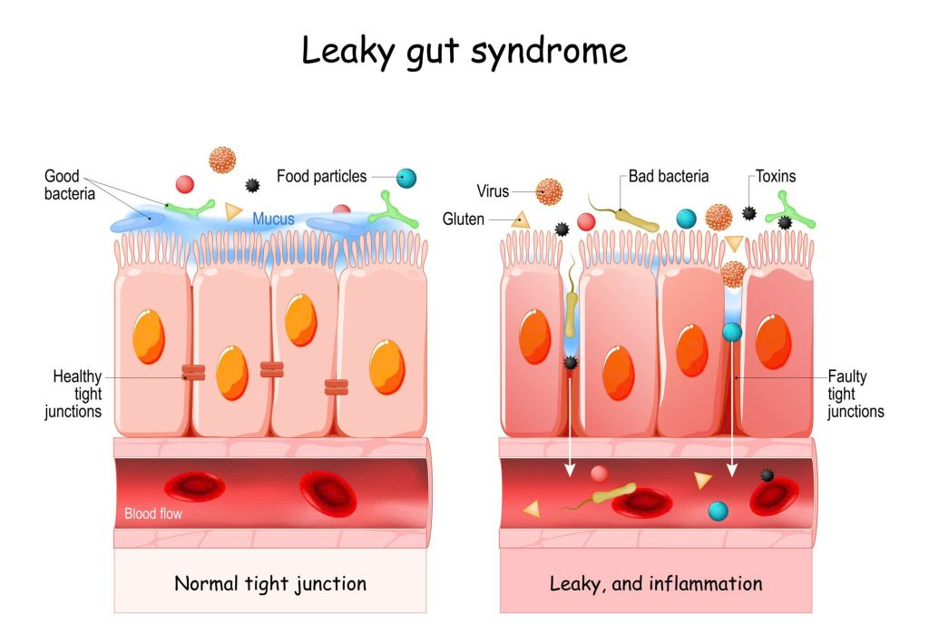 Leaky gut